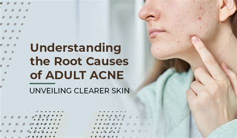 Understanding the Root Causes of Adult Acne | Acne Wiki