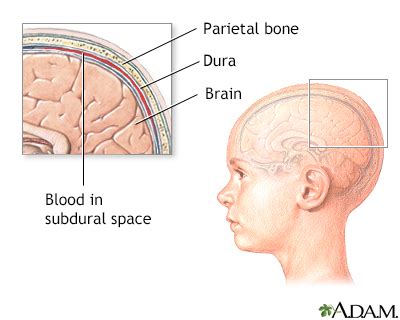 Subdural hematoma Information | Mount Sinai - New York