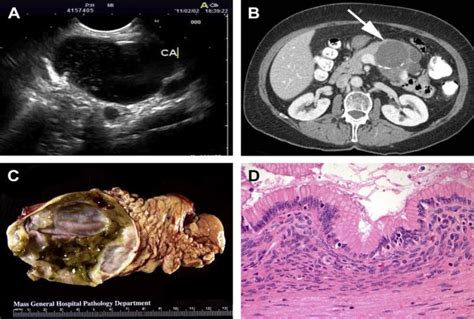 Mucinous cystic neoplasm in body and tail of the pancreas. Female... | Download Scientific Diagram