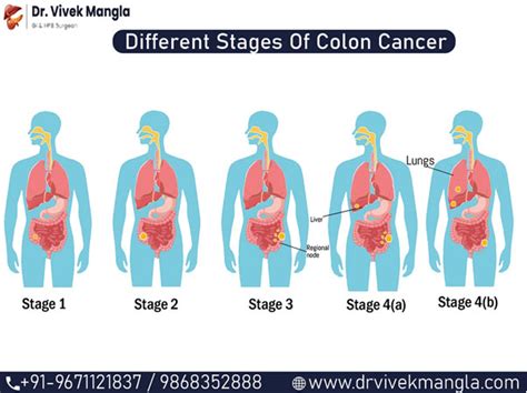 Different Stages of Colon Cancer