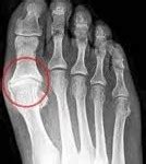 Treatment of Toe Injuries : Broken, Sprained, Fractured, Stubbed, or ...