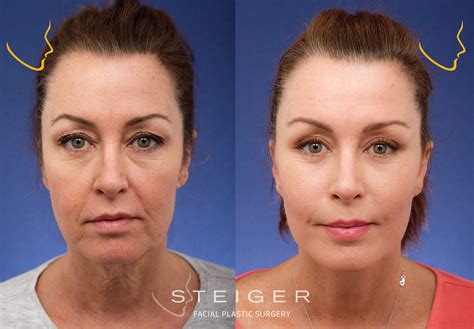 Facelift Before and After Photos | Deep Plane Facelift