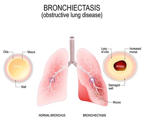 Mucus In Lungs