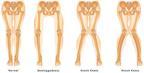 Knee Angular Deformities (Knock legs and Bow legs) | Orthopaedic ...