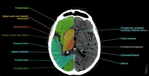 Axial Brain Anatomy