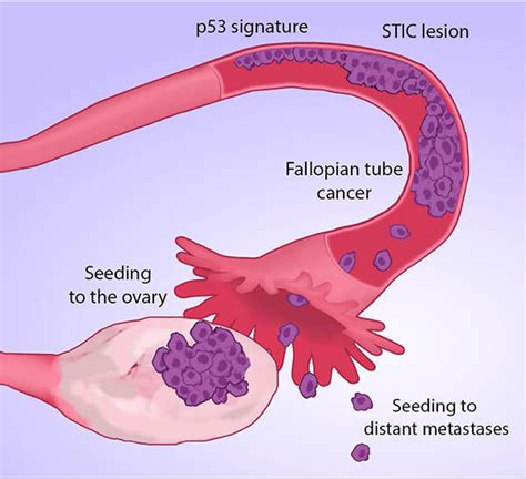 Many Ovarian Cancers May Start in Fallopian Tubes - NCI