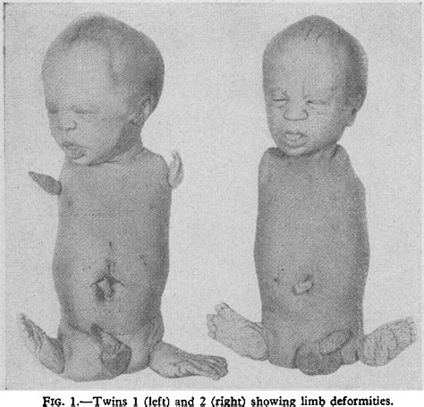 Figure 1 from 524 2 December 1967 Congenital Phocomelia in Monozygotic Twins - Semantic Scholar