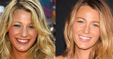 Pin by K-tizzle on Style n Vibe | Nose job, Blake lively nose, Rhinoplasty