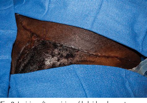 Figure 2 from What Causes Keloid Formation ? What are the Risk Factors ...