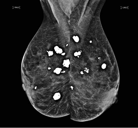 Breast Cyst Mammogram