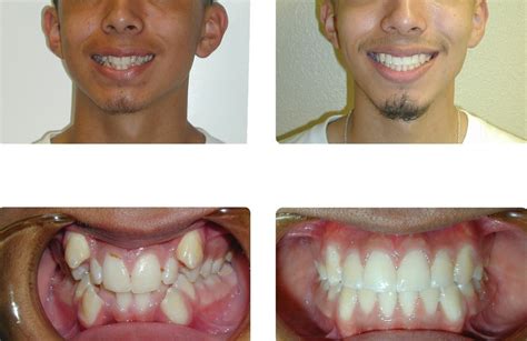 Orthodontic Before and After Photos | Brodsky Orthodontics