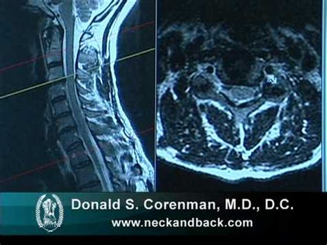 Understanding an MRI of a Cervical Nerve Compression | Colorado