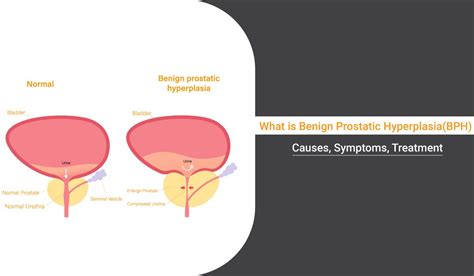 Benign Prostatic Hyperplasia (BPH): Causes, Symptoms, and Treatment