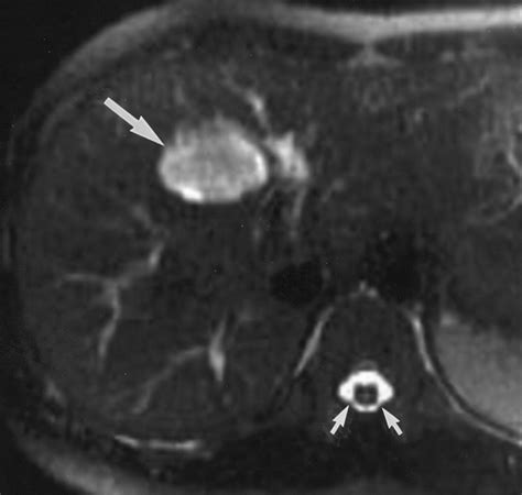 Hepatic Hemangioma: Atypical Appearances on CT, MR Imaging, and Sonography | AJR