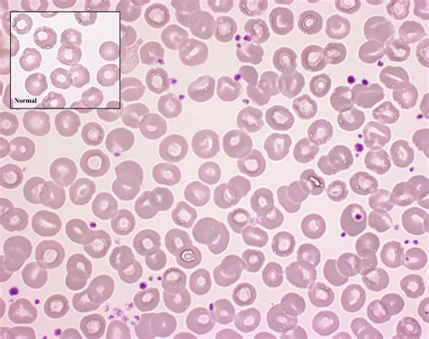 Polycythemia Vera Peripheral Smear