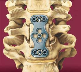 Cervical Corpectomy » SONSA