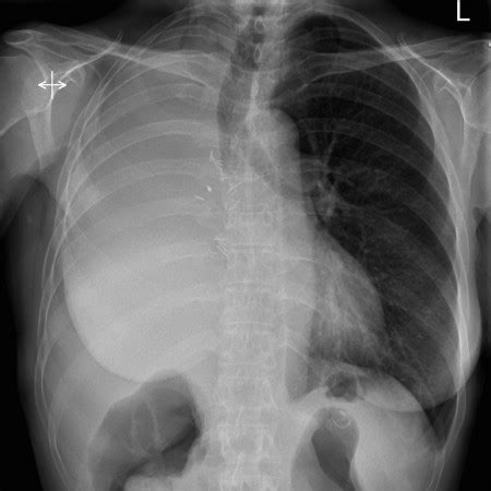 Pneumonectomy - Radiology at St. Vincent's University Hospital