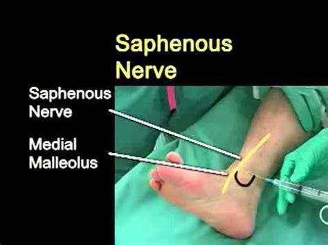 Ankle Block | Ankle, Blocks, Anesthesia