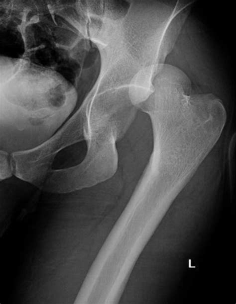 Hip Dislocation - Emergency Medicine Kenya Foundation