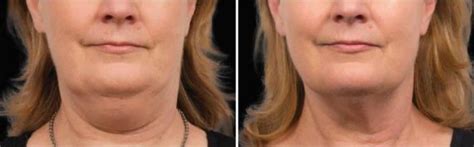 Eliminate Turkey Neck: Proven Tips & Treatments