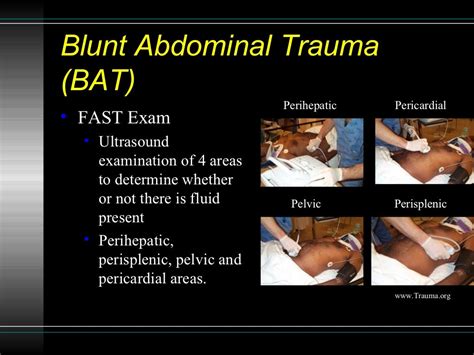 Sonographic Assessment of Blunt Abdominal Trauma in the Emergency Dep…