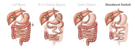 Affordable Duodenal Switch Surgery in Tijuana by an Expert Surgeon