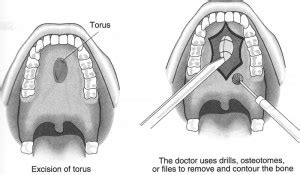 Mandibular torus - ENT Clinic