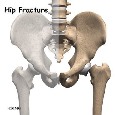 Hip Fractures - Orthogate