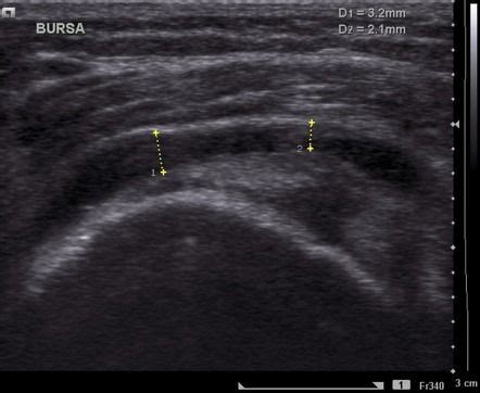 Subdeltoid-subacromial bursitis | Radiology Case | Radiopaedia.org | Radiology, Medical ...