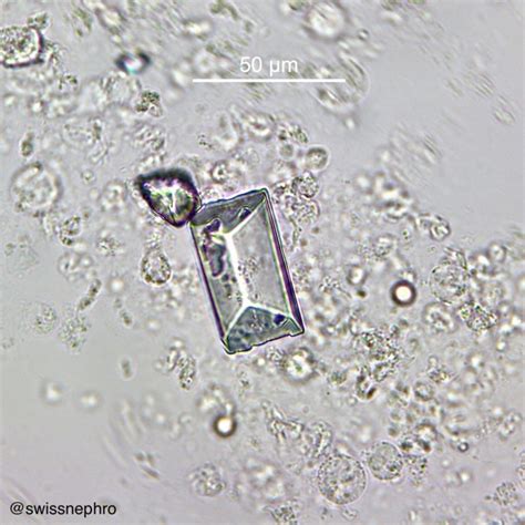 Urine Sediment of the Month: Common Crystals! - Renal Fellow Network