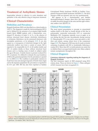 Brugada syndrome | PDF