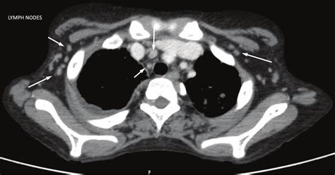 CT scan of the chest showing hilar and axillary lymphadenopathy (arrows... | Download Scientific ...