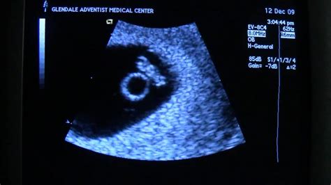 Ultrasound 6 weeks 6 days - Heartbeat! - YouTube