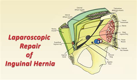 Laparoscopic Repair of Inguinal Hernia | Healthcare