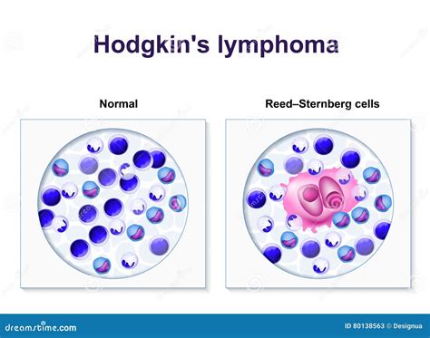 Hodgkin s lymphoma stock vector. Illustration of lymphoma - 80138563