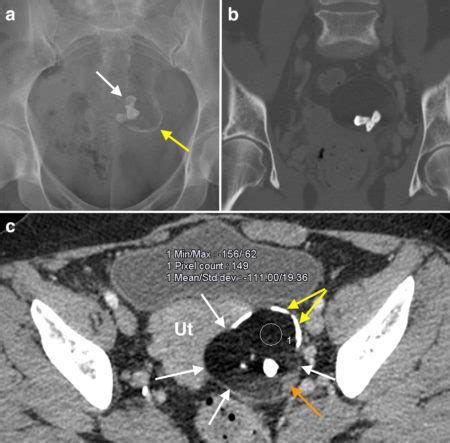 Ovarian dermoid cyst - Radiology at St. Vincent's University Hospital