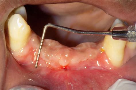 Cureus | Management of Shallow Vestibule with Reduced Attached Gingiva in Fixed Prosthetic ...