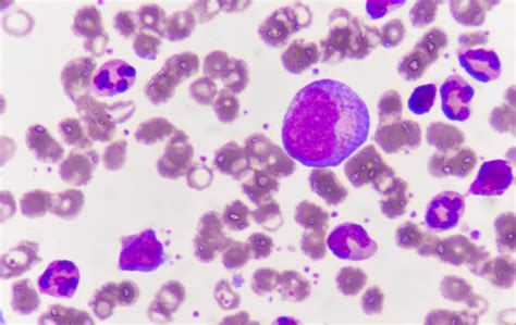 Chronic Myeloid Leukemia: What Your Patients Need to Know - Cancer Therapy Advisor