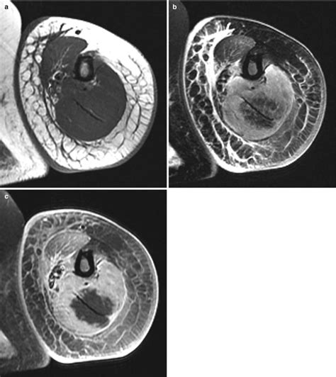 Fig. 17.11, [Myonecrosis in a 73-year-old woman...]. - Musculoskeletal Diseases 2021-2024 - NCBI ...