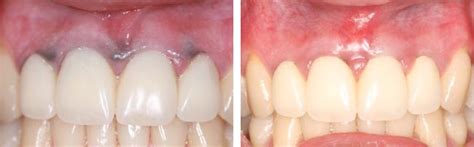 Laser De-Pigmentation New York, Laser Gum Bleaching, Discolored Gums