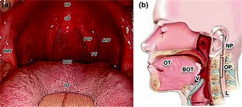 Clinical Presentation of HPV-Driven Oropharyngeal Carcinoma | SpringerLink