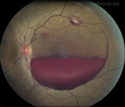 Vitreous Hemorrhage: From One Medical Student to Another