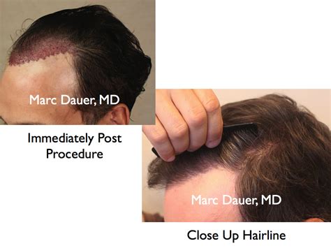 Natural Hairline Design in Hair Transplant Procedures | Marc Dauer, MD ...