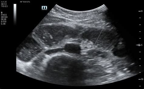 Point of Care Ultrasound Illustrating Small Bowel Obstruction - JETem