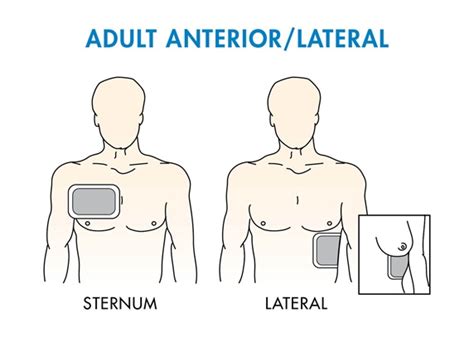 AED Pad Placement | Heartsmart