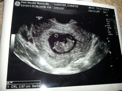 First Ultrasound - 9 Weeks ~ Christie Koester