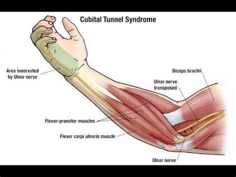 Flexor carpi ulnaris & radialis rehab. for Golfer's elbow, ulnar nerve entrapment and wrist pain ...