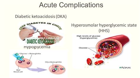 Diabetic Hyperosmolar Syndrome