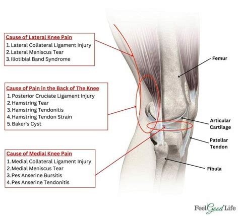 Knee Pain Location Chart SPORT Orthopedics Dallas And, 52% OFF