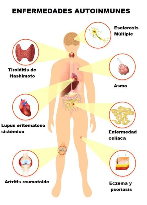 Signos de una enfermedad autoinmune y cómo revertirla | Enfermedades autoinmunes, Tiroides ...